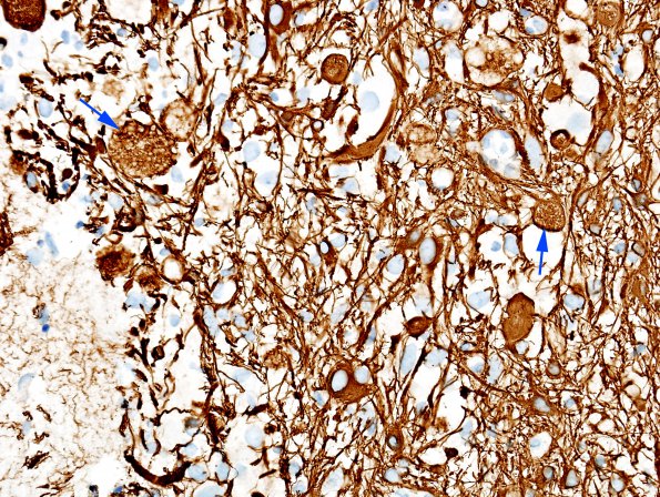 8F2 Ganglioglioma (Case 8) GFAP 1 copy