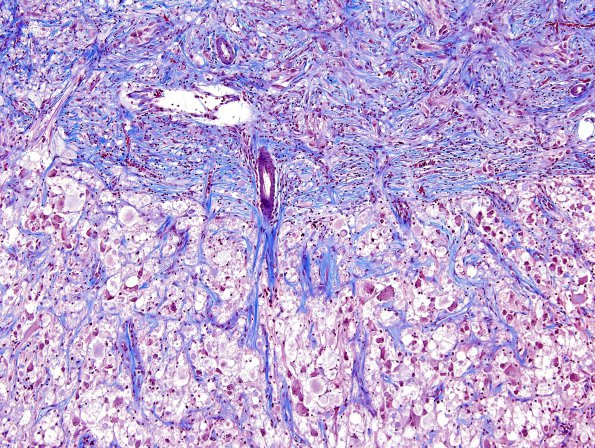 8G1 Ganglioglioma (Case 8) Trichrome 6