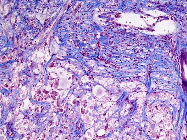 8G2 Ganglioglioma (Case 8) Trichrome 7