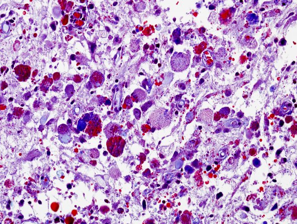 8G3 Ganglioglioma (Case 8) Trichrome 4