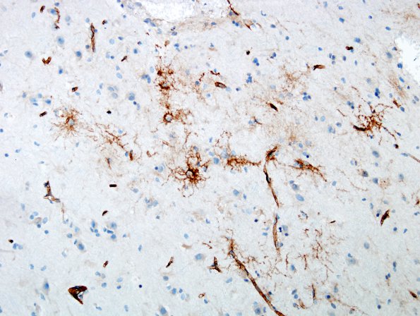 8I Ganglioglioma (Case 8) CD34 1