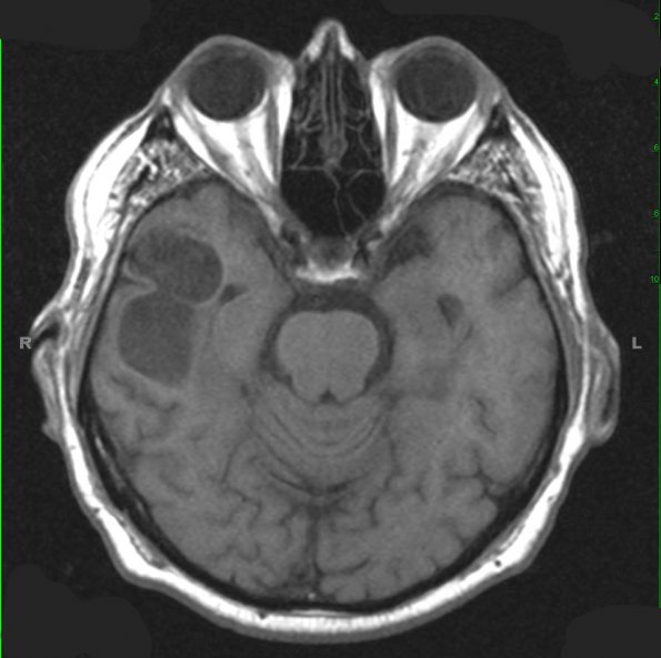 9A1 Ganglioglioma (Case 9) T1 1 - Copy