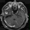 9A2 Ganglioglioma (Case 9) T1 W 1 - Copy