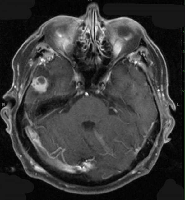 9A2 Ganglioglioma (Case 9) T1 W 1 - Copy