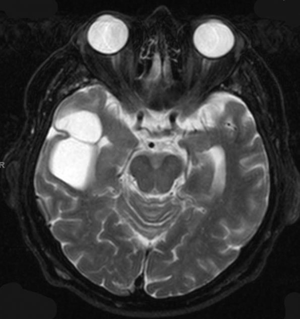 9A3 Ganglioglioma (Case 9) T2 W 1 - Copy