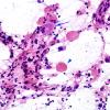 9B1 Ganglioglioma (Case 9) Smear H&E 6 copy