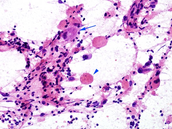 9B1 Ganglioglioma (Case 9) Smear H&E 6 copy