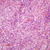 9B2 Ganglioglioma (Case 9) H&E 30