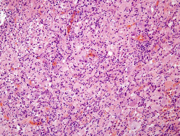 9B2 Ganglioglioma (Case 9) H&E 30