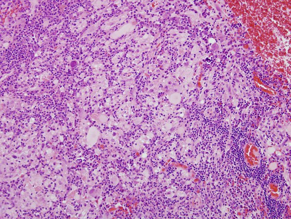 9B3 Ganglioglioma (Case 9) H&E 20 (2)