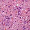 9B5 Ganglioglioma (Case 9) H&E 17