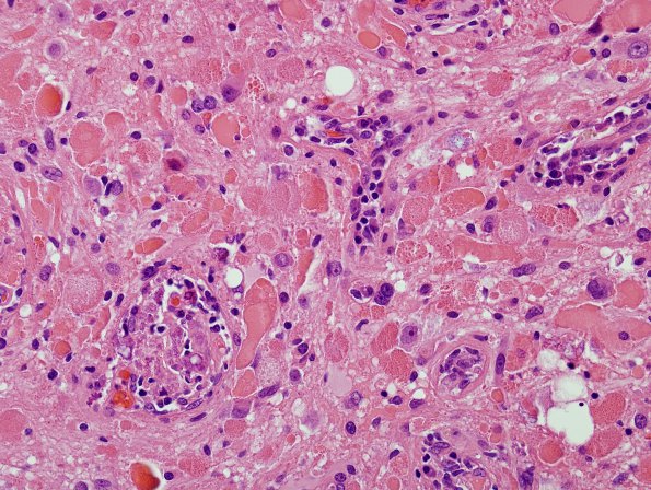 9B5 Ganglioglioma (Case 9) H&E 17