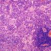 9B6 Ganglioglioma (Case 9) H&E 25