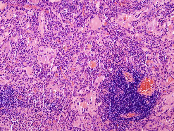 9B6 Ganglioglioma (Case 9) H&E 25