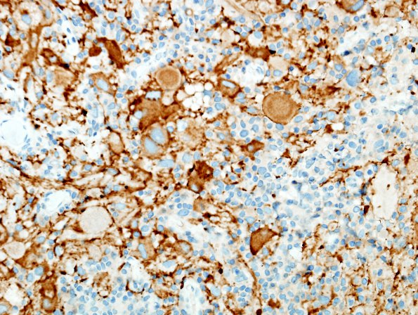 9C1 Ganglioglioma (Case 9) SYN 10 (2)