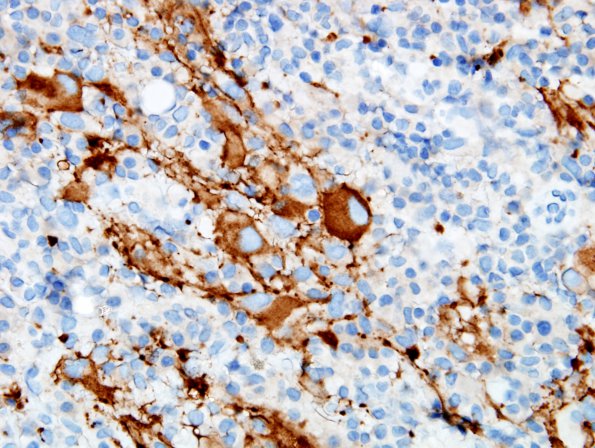 9C2 Ganglioglioma (Case 9) SYN 1