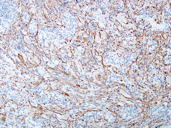 9D1 Ganglioglioma (Case 9) NF 5