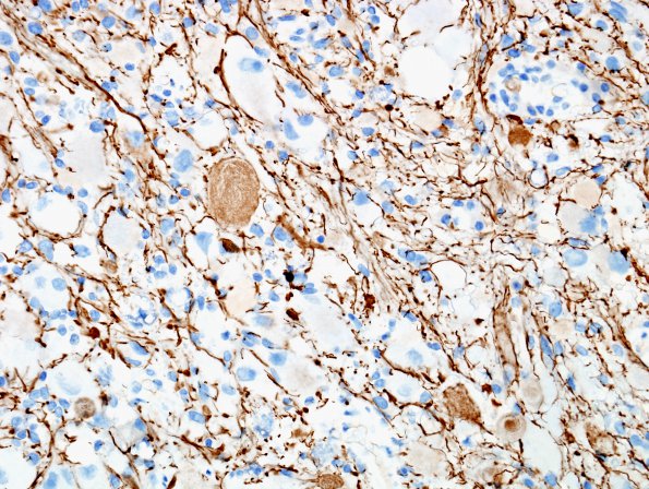 9D2 Ganglioglioma (Case 9) NF 1