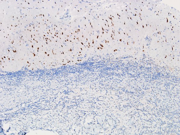 9E1 Ganglioglioma (Case 9) NeuN 1