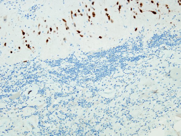 9E2 Ganglioglioma (Case 9) NeuN 5 (2)