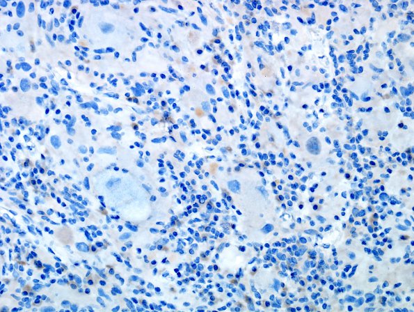 9E3 Ganglioglioma (Case 9) NeuN 6