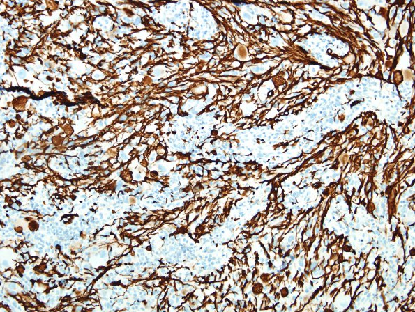 9F1 Ganglioglioma (Case 9) GFAP 4 (2)