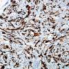 9F2 Ganglioglioma (Case 9) GFAP 5