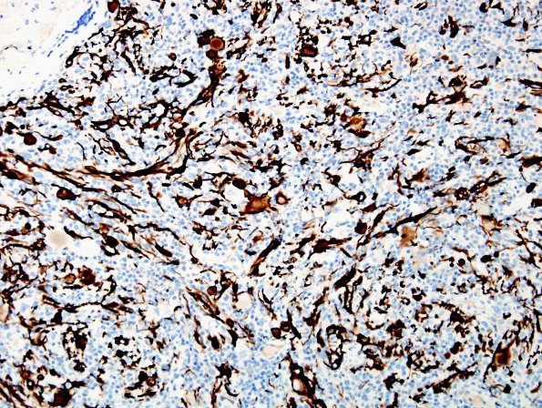 9F2 Ganglioglioma (Case 9) GFAP 5