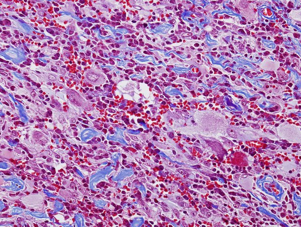 9G1 Ganglioglioma (Case 9) Trichrome 1