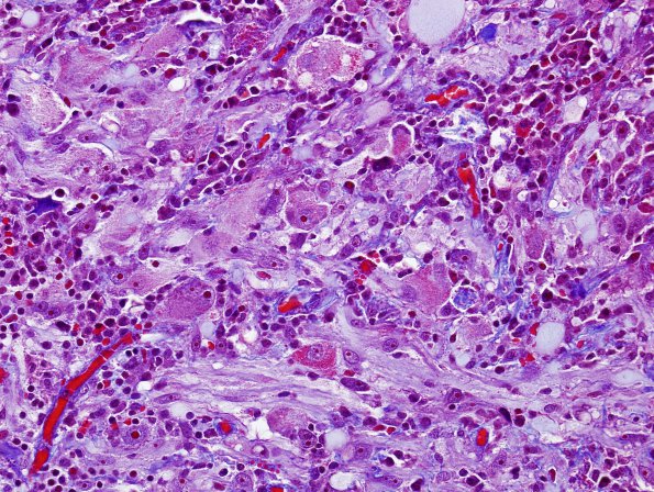 9G2 Ganglioglioma (Case 9) Trichrome 5