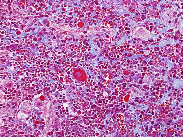 9G3 Ganglioglioma (Case 9) Trichrome 3