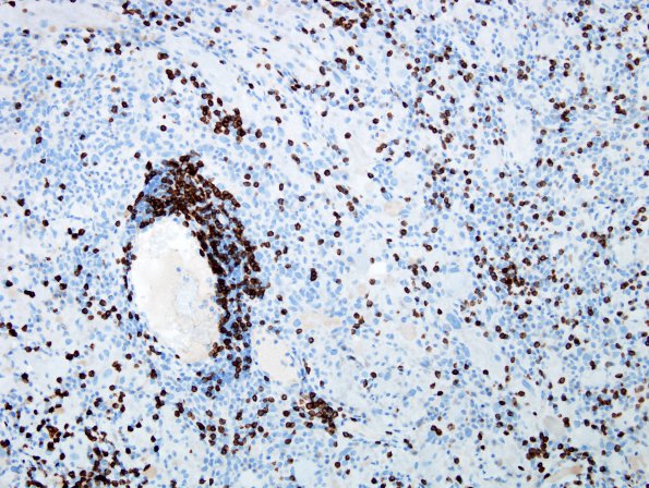 9H1 Ganglioglioma (Case 9) CD3 1