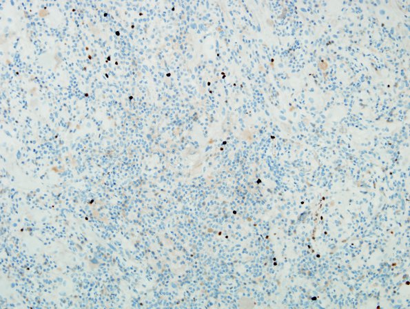 9I Ganglioglioma (Case 9) Ki67 5