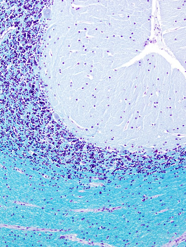 0C2 Lhermitte-Duclos (Case 0) control LFB-PAS 20X