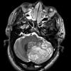 1A Lhermitte-Duclos Dz (Case 1) T2W - Copy