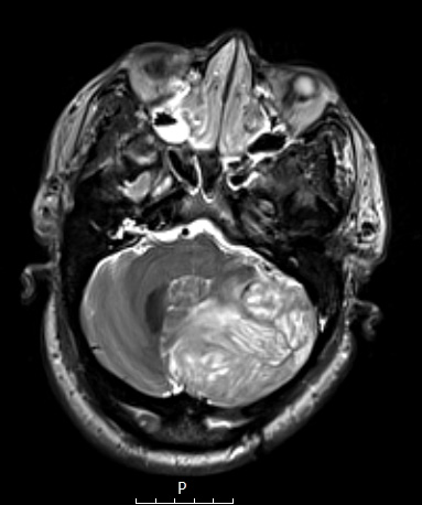 1A Lhermitte-Duclos Dz (Case 1) T2W - Copy