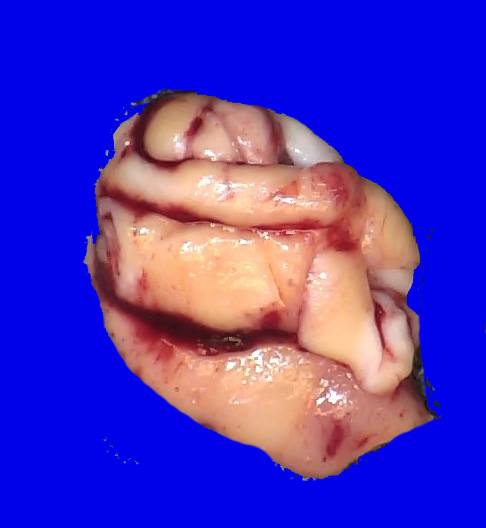 1B1 Lhermitte-Duclos Dz (Case 1) _1