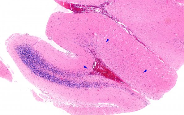 1C1 Lhermitte-Duclos Dz (Case 1) A2 4X copy