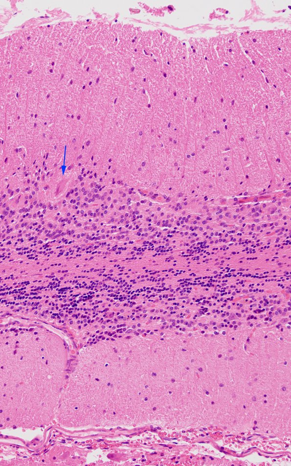 1C5 Lhermitte-Duclos Dz (Case 1) A3 H&E 20X copy