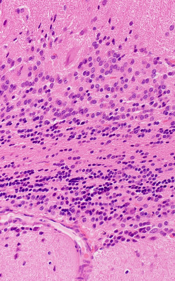 1C6 Lhermitte-Duclos Dz (Case 1) A3 H&E 40X