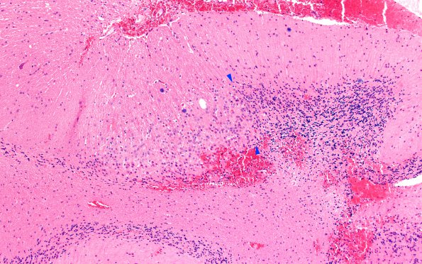 1D2 Lhermitte-Duclos Dz (Case 1) H&E 10X copy