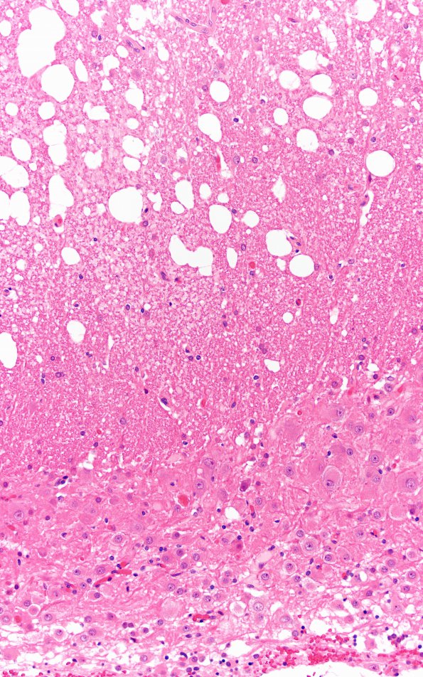 1E3 Lhermitte-Duclos Dz (Case 1) B1 20X 2