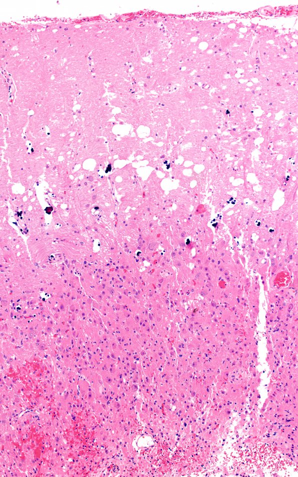 1E4 Lhermitte-Duclos Dz (Case 1) B12 10X 2