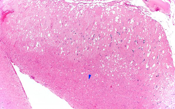 1F2 Lhermitte-Duclos Dz (Case 1) 4X copy