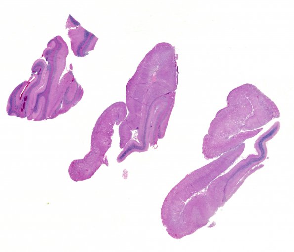 1G0 Lhermitte-Duclos Dz (Case 1) A3 H&E 1