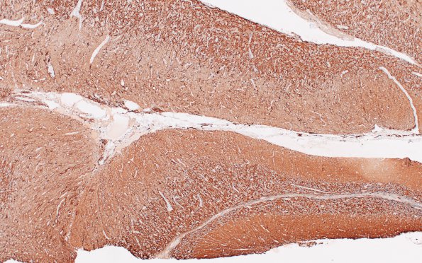 1G2 Lhermitte-Duclos Dz (Case 1) A3 SYN WM 4X