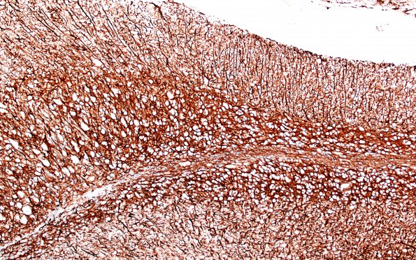 1J4 Lhermitte-Duclos Dz (Case 1) A3 GFAP 10X 2