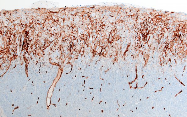 1K2 Lhermitte-Duclos Dz (Case 1) A3 CD34 10X