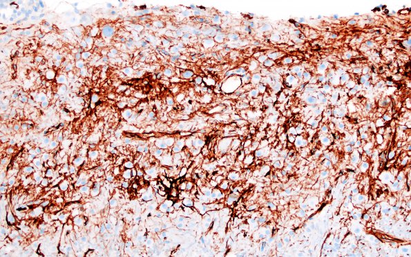 1K3 Lhermitte-Duclos Dz (Case 1) A3 CD34 20X 3