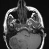 2A2 Lhermitte-Duclos (Case 2) T1 1 - Copy